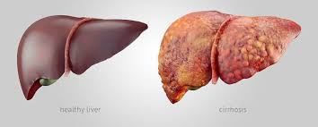  Liver Cancer Treatment in Electronic City